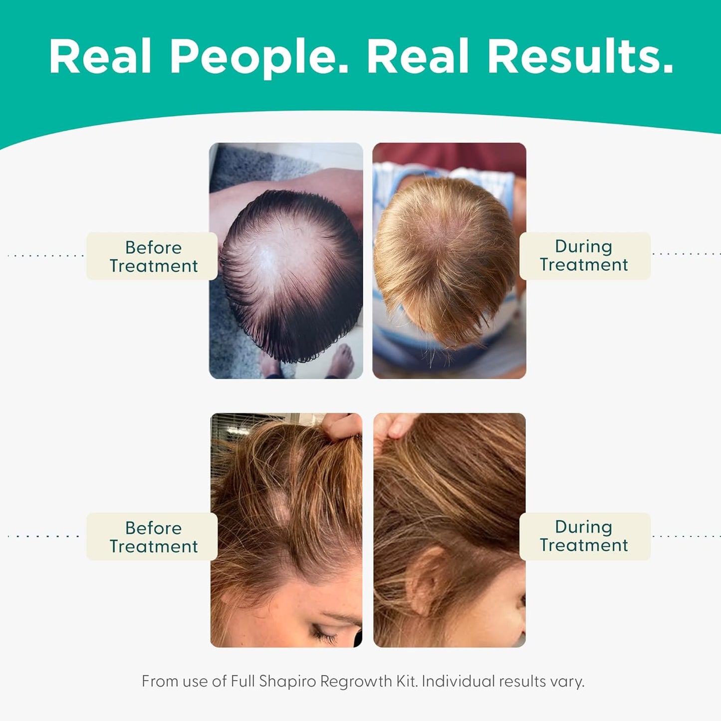 Shapiro MD Hair Growth Experts Hair Loss Leave-In Daily Foam, DHT Fighting Vegan Formula for Thinning Hair Developed by Dermatologists, Experience Healthier, Fuller, 2 Month Supply