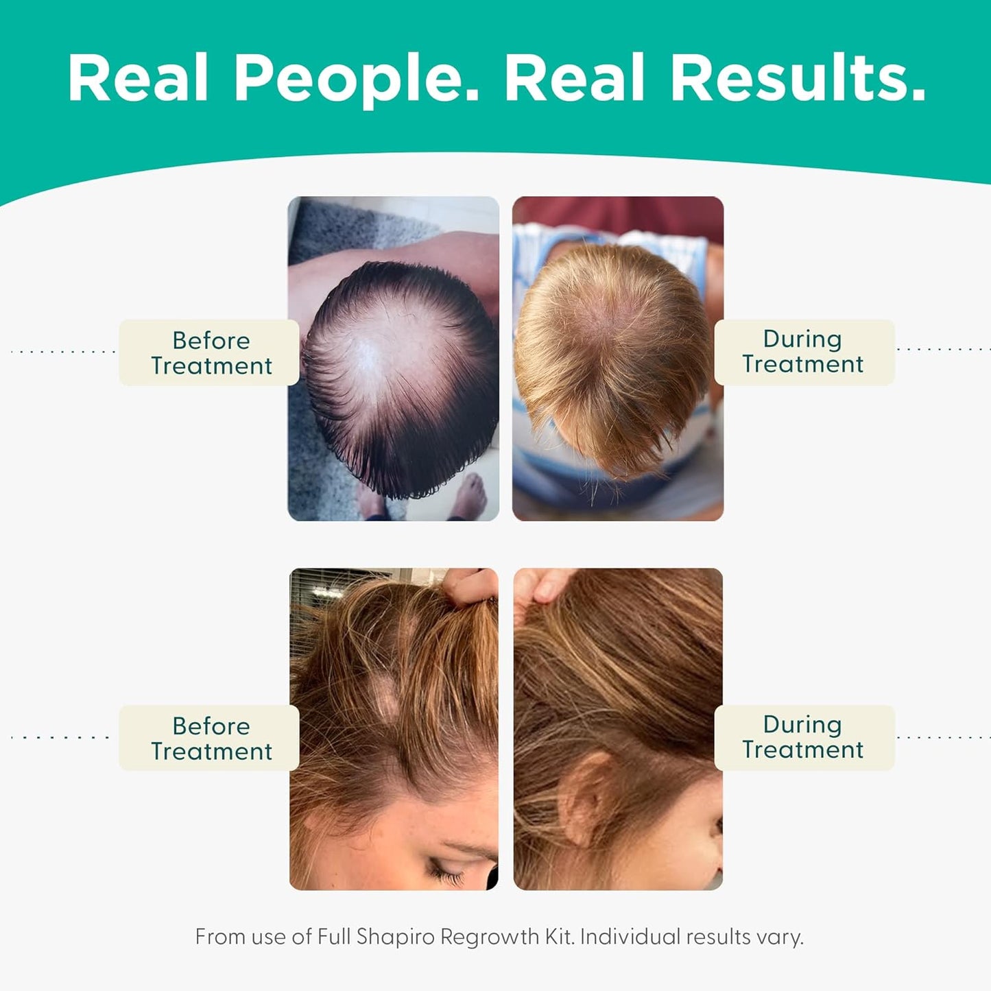 Shapiro MD Hair Growth Experts Leave-In Daily Foam, DHT Fighting Vegan Formula for Thinning Hair Developed by Dermatologists, Experience Healthier, Fuller & Thicker Looking Hair - 4 Month Supply