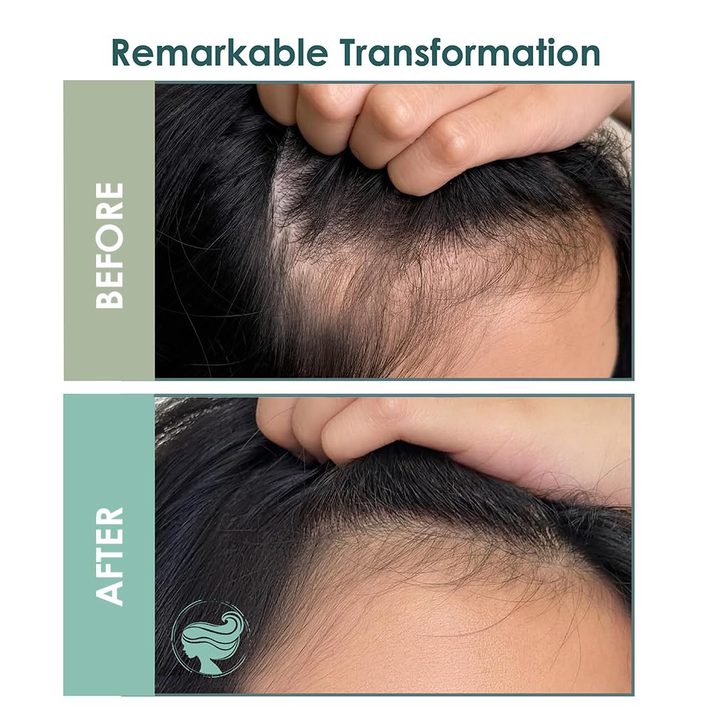 SH-RD Intensive Scalp Essence for Hair Regrowth & Volumizing | With Rosemary, Protein, Vitamin B5 | Lightweight Serum for Thinning Hair - 50ml/1.69oz